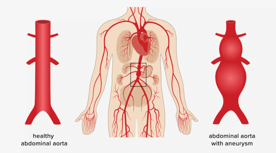 Description of the condition of abdominal aortic aneurysm